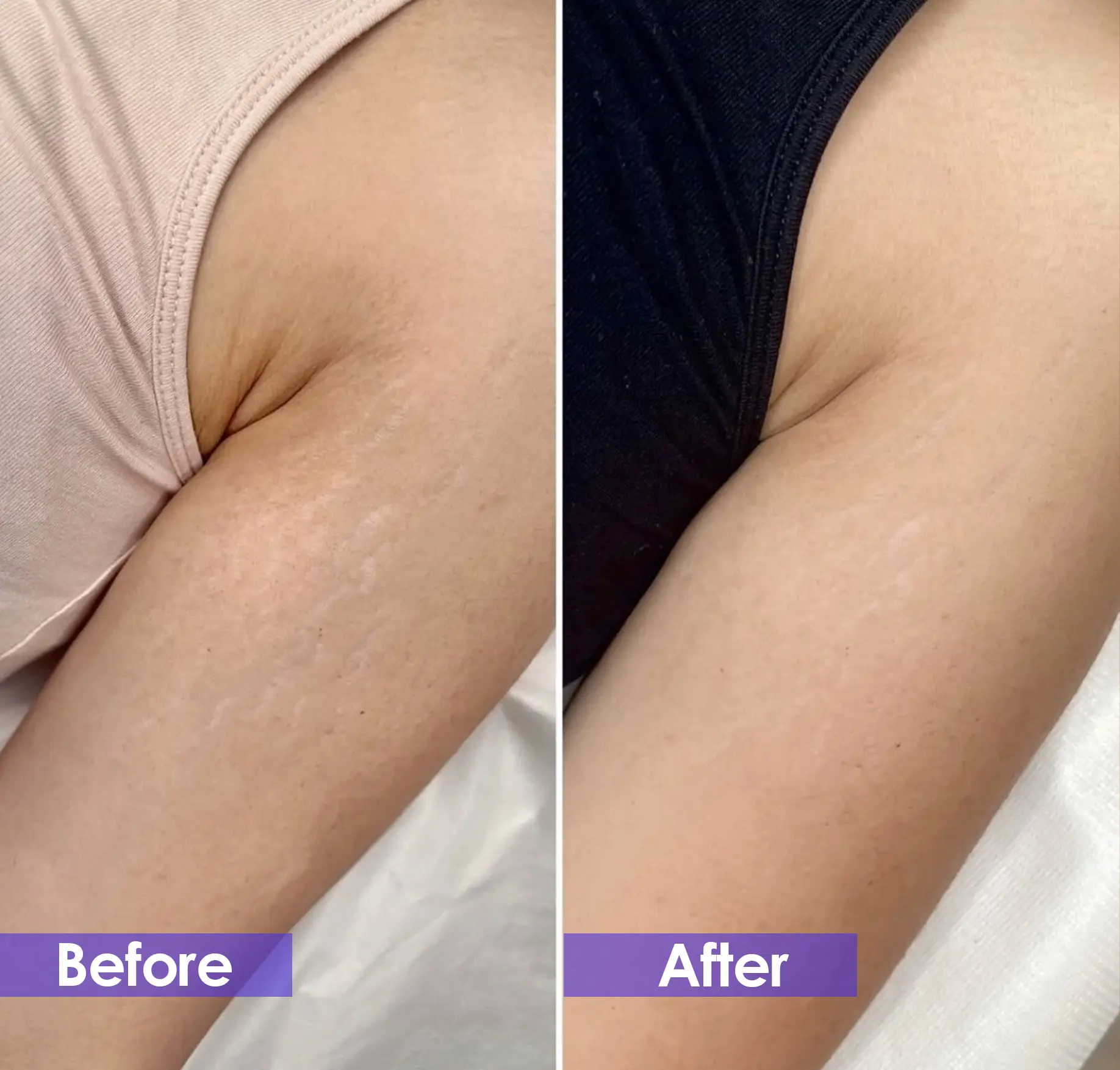 Before and after removal of arm stretch marks